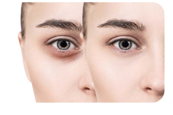 کربوکسی تراپی