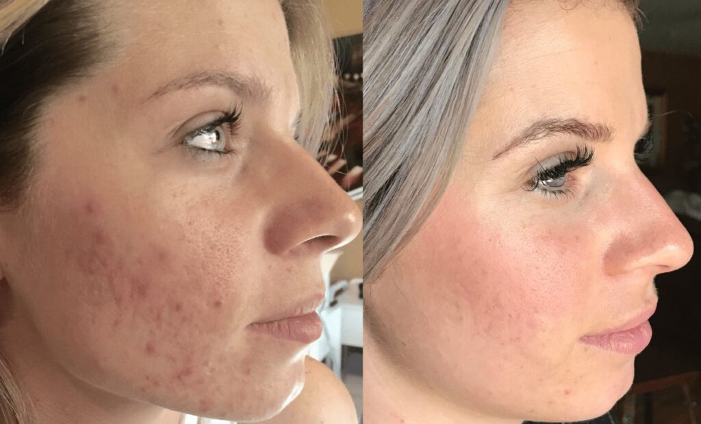 مرکز مزونیدلینگ در ظفر