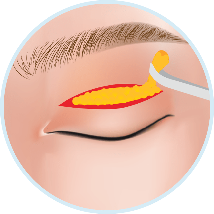 مرکز بلفاروپلاستی در ظفر