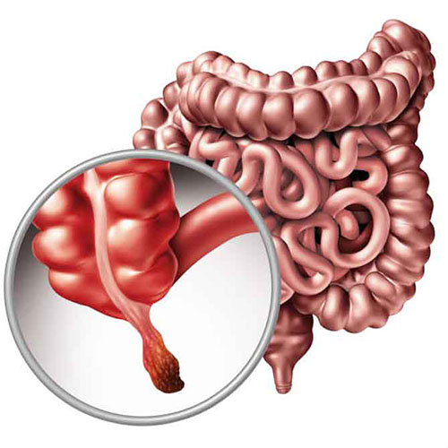 مرکز جراحی آپاندیس