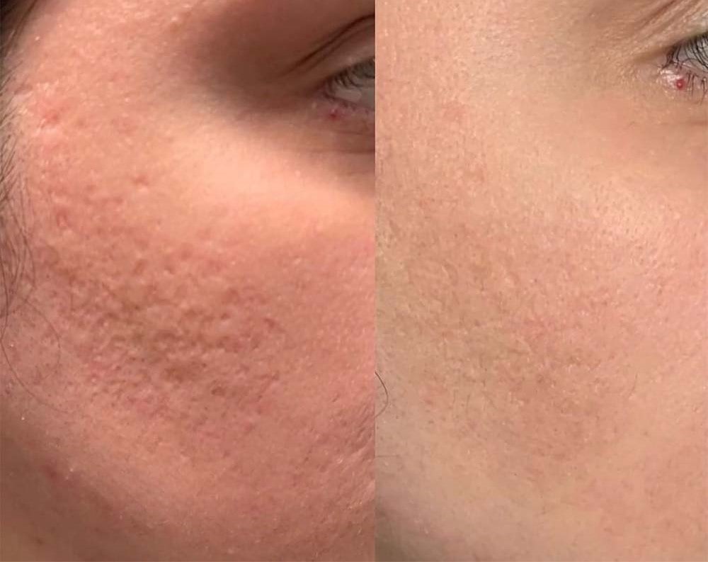 مرکز مزونیدلینگ در ظفر