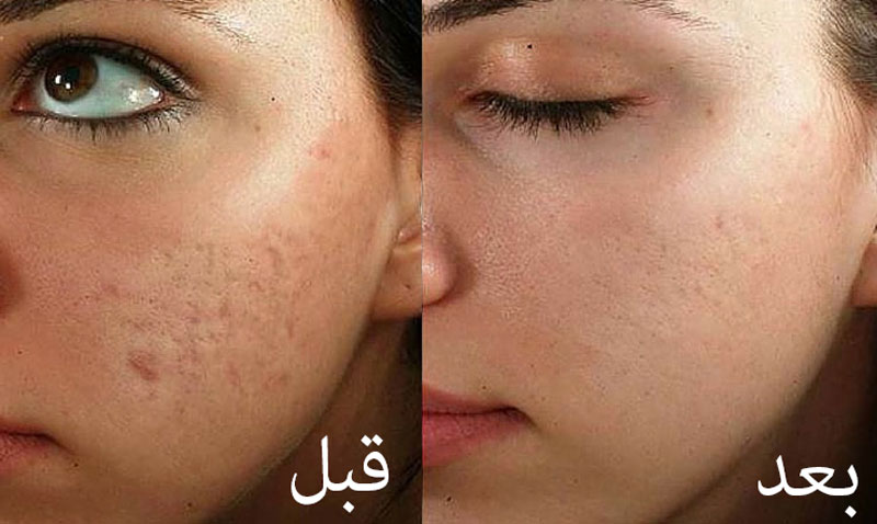 مرکز مزونیدلینگ در ظفر