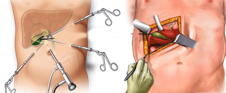 بهترین جراح کیسه صفرا