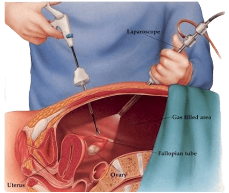 مرکز لاپاراسکوپی