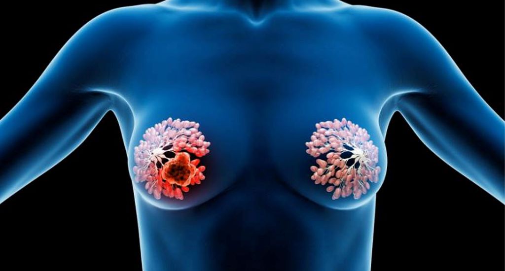 جراحی توده پستان