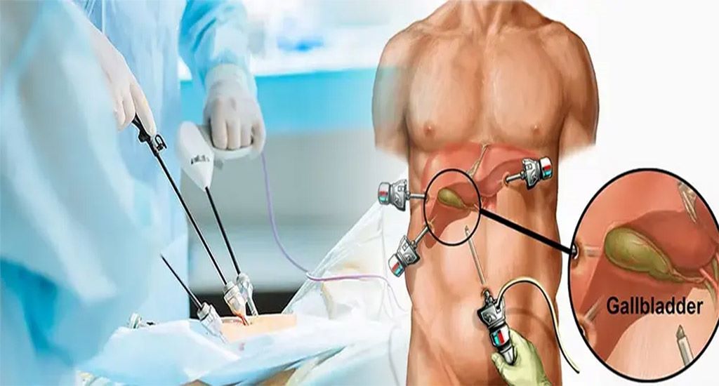 جراحی کیسه صفرا