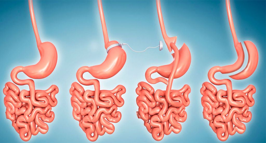 جراحی باریاتریک