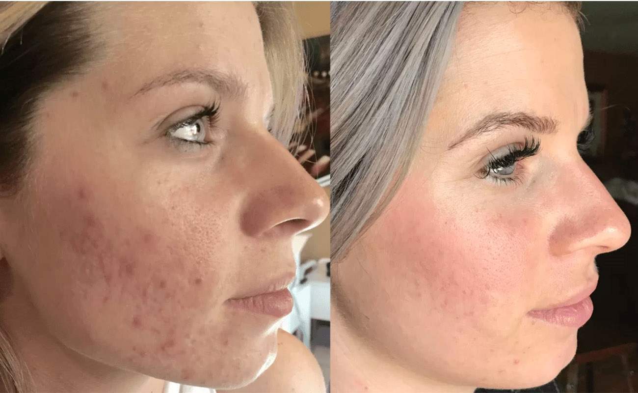 Microneedling center in Zafar