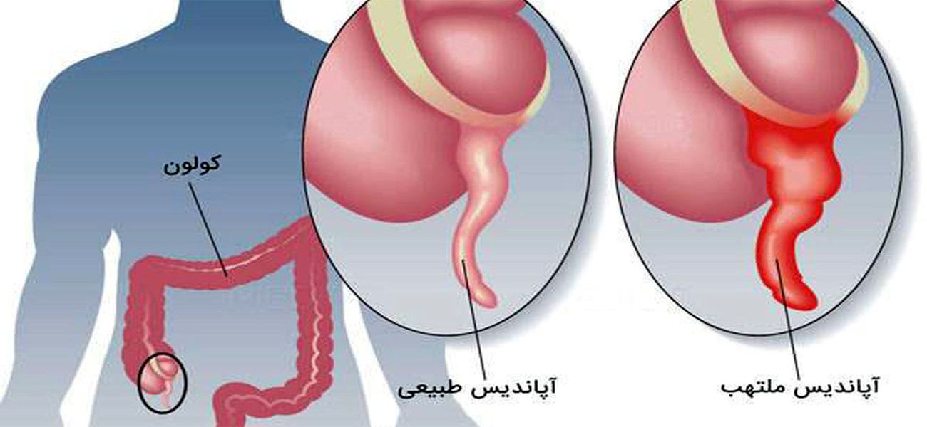 أفضل جراح الزائدة الدودية في ظفر